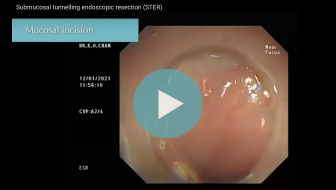 Submucosal tunnelling endoscopic resection (STER)